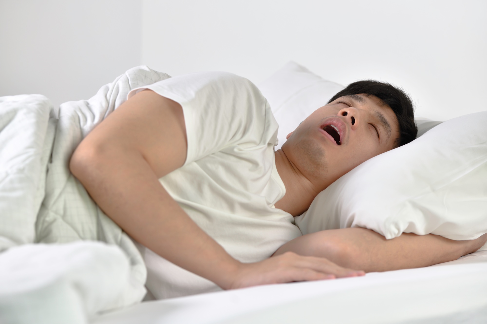 Man sleeping with mouth open, highlighting symptoms of sleep apnea and the need for treatment at Sierra Sleep, Airway & Wellness Center to improve airway health and overall well-being.